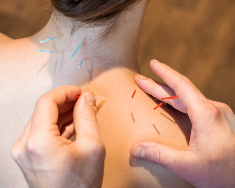Akupunktur-Nadeln werden an einen Patienten gesetzt